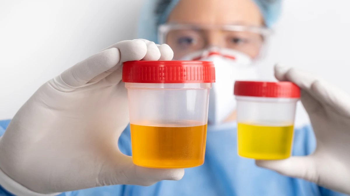 Dark-Colored Urine or Pale Stools