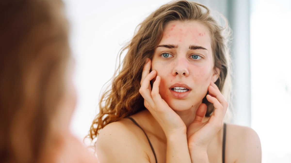 Skin Breakouts and Puffiness