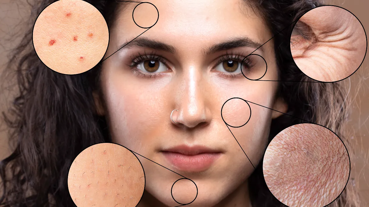 Skin Changes: Skin Tags & Dark Patches