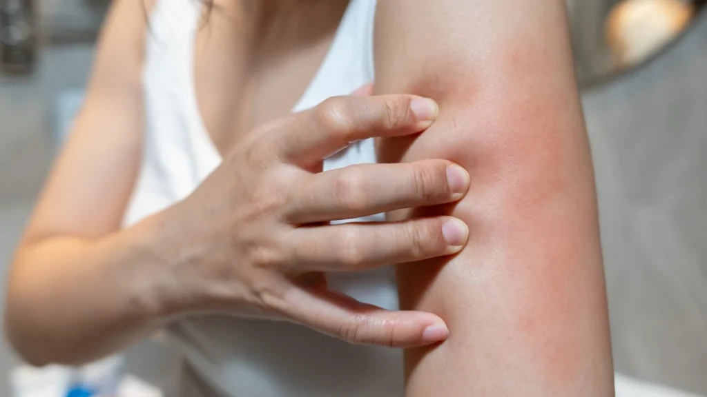 Frequent Skin Rashes or Eczema
