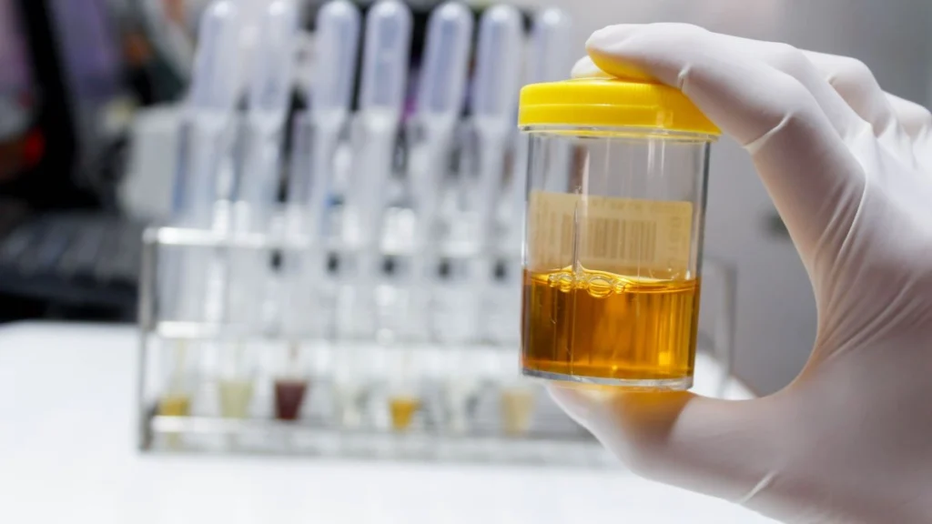 Dark Urine and Pale Clay Colored Stools