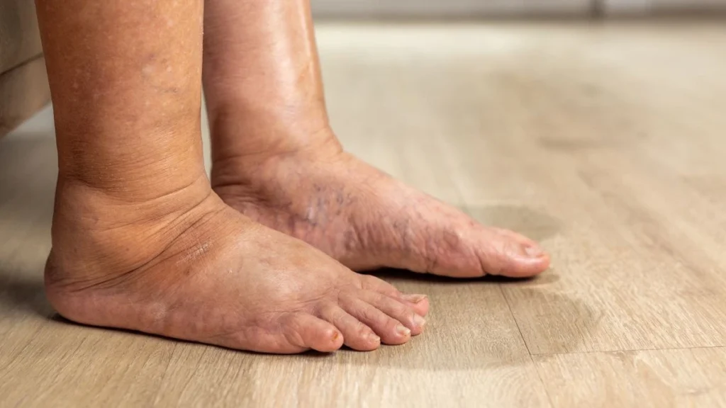 Unexplained Swelling in Legs and Ankles