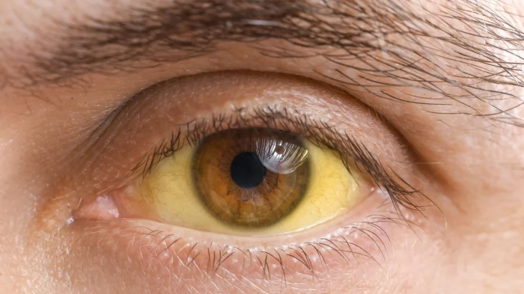 Subtle Yellowing of the Eyes