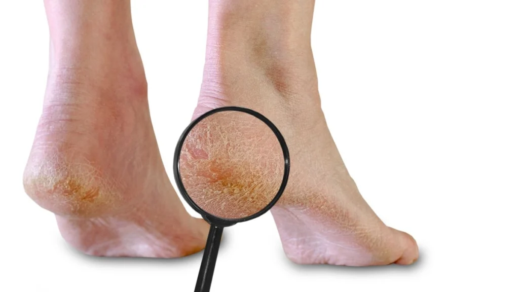 Sores on Your Feet or Legs That Won't Heal