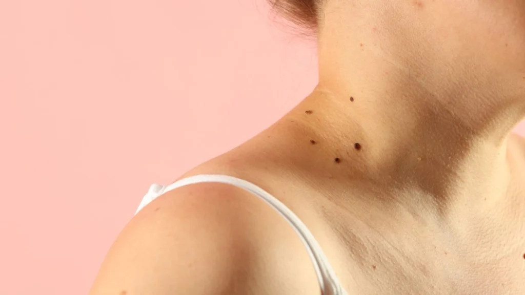 Skin tags