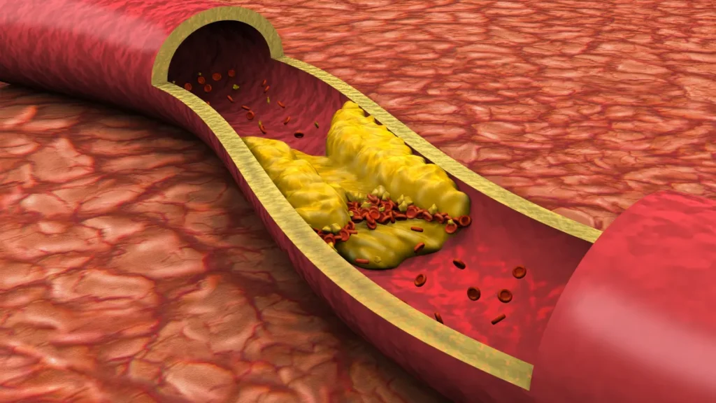 Why the Old Cholesterol Approach Failed Us