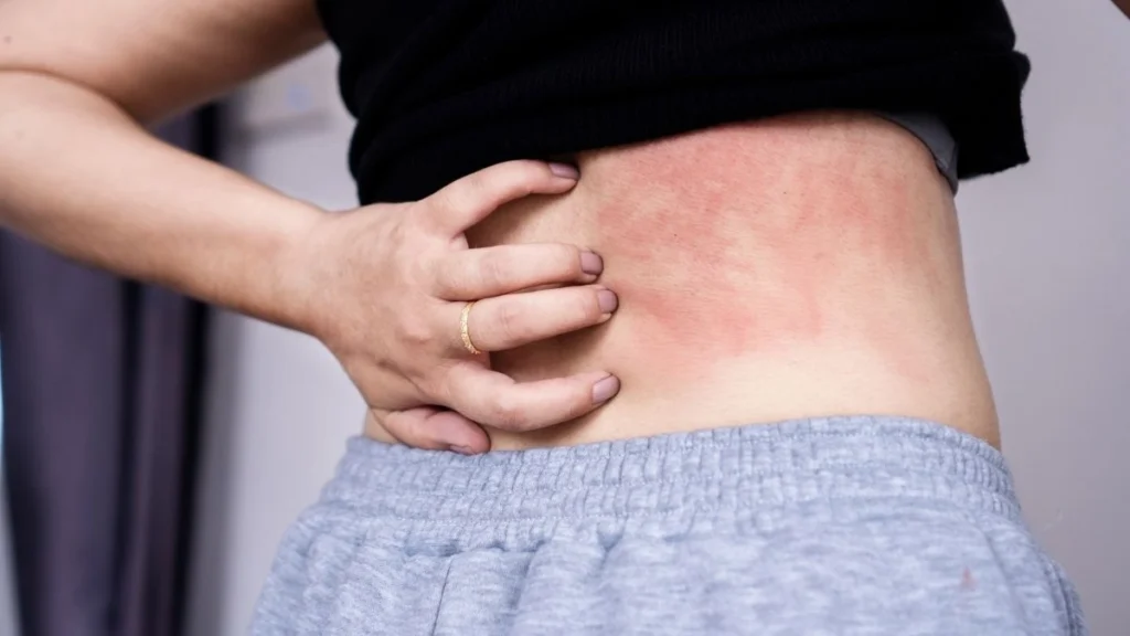 The Kidney Rash