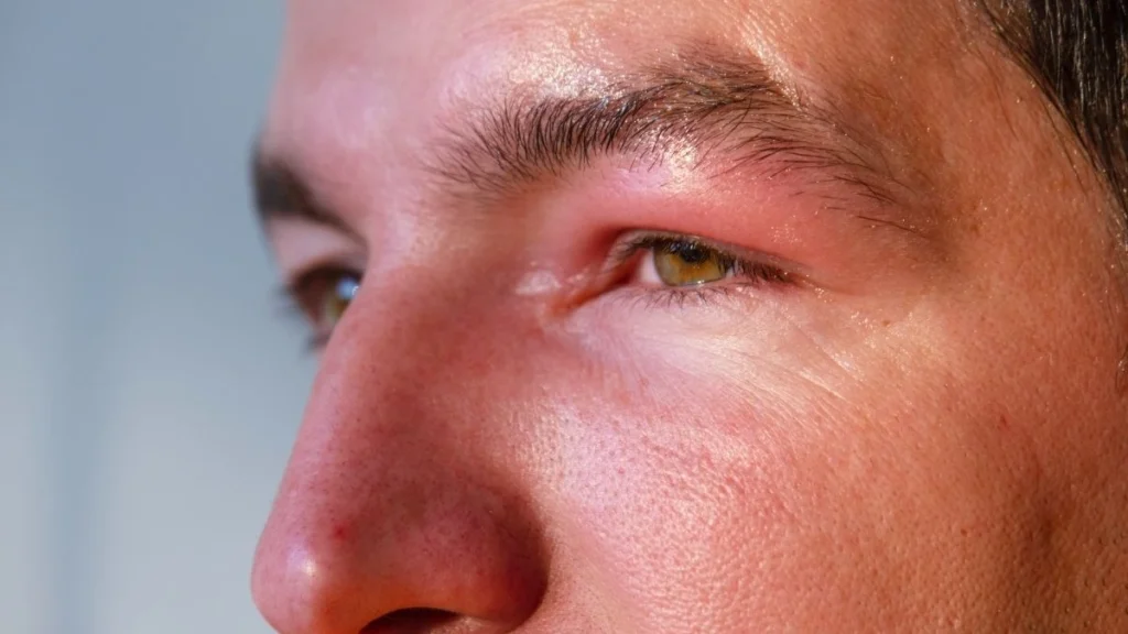 Puffy Swelling Around the Eyes