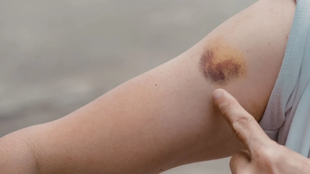 Unexplained Bruising and Purple Spots
